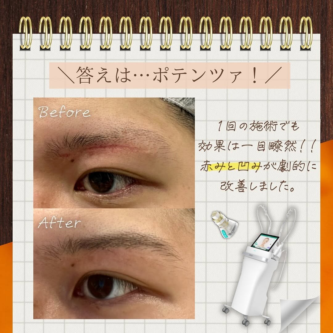 他院眉下切開後の赤みと凹みが残る傷跡をポテンツァで改善した修正症例 画像2