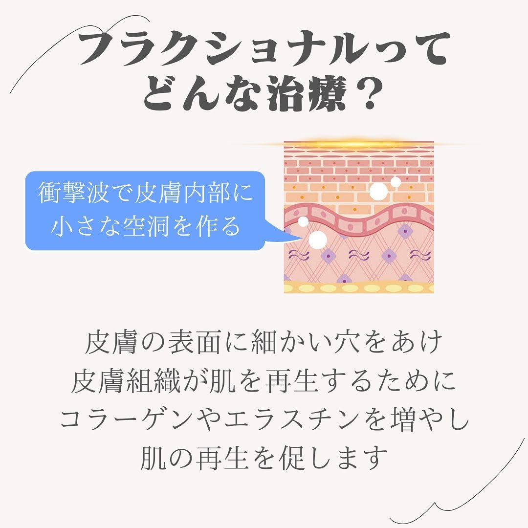 1064フラクショナルとは｜衝撃波で毛穴・ニキビ跡・小じわをコラーゲン再生で改善 画像2
