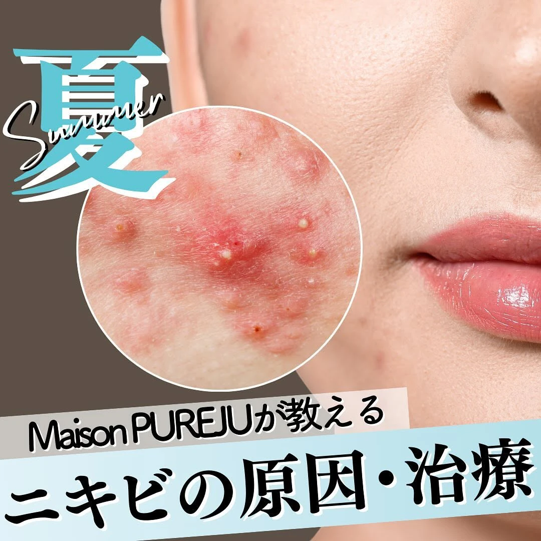夏のニキビの原因と治療法|紫外線・エアコン乾燥・皮脂過剰・ターンオーバー乱れへの4つのアプローチ