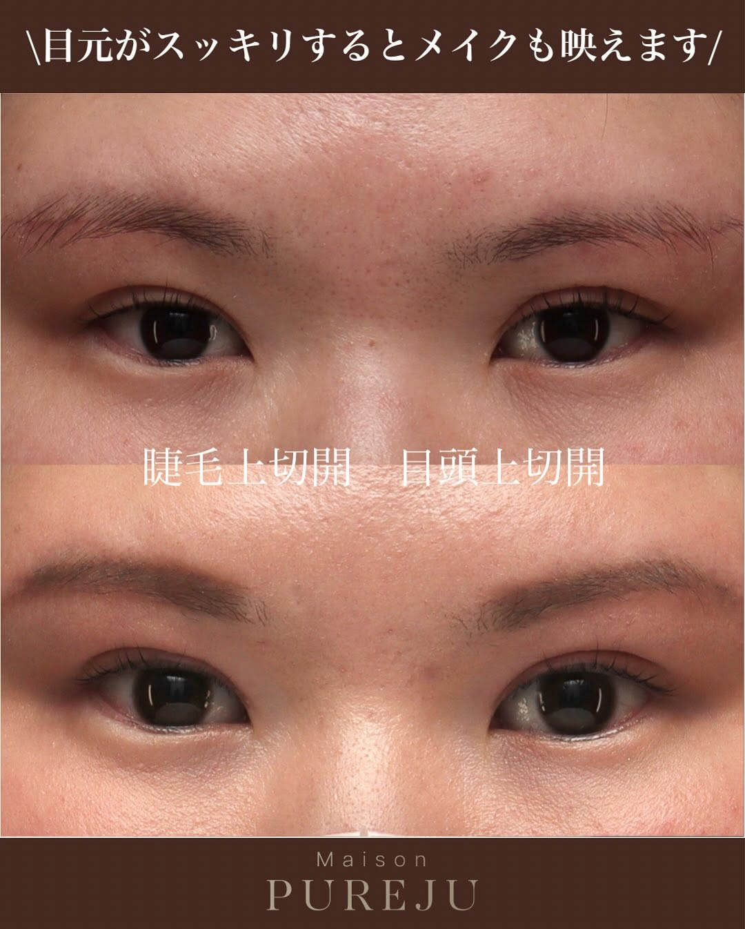 睫毛上切開でまつ毛と二重ラインの間のもたつきを改善しすっきりした目元にした症例 画像2