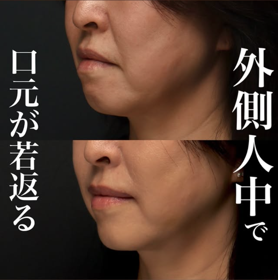 外側人中短縮＋ボトックスリフト＋ショートスレッドで下顔面を若返らせた症例（術後1ヶ月）
