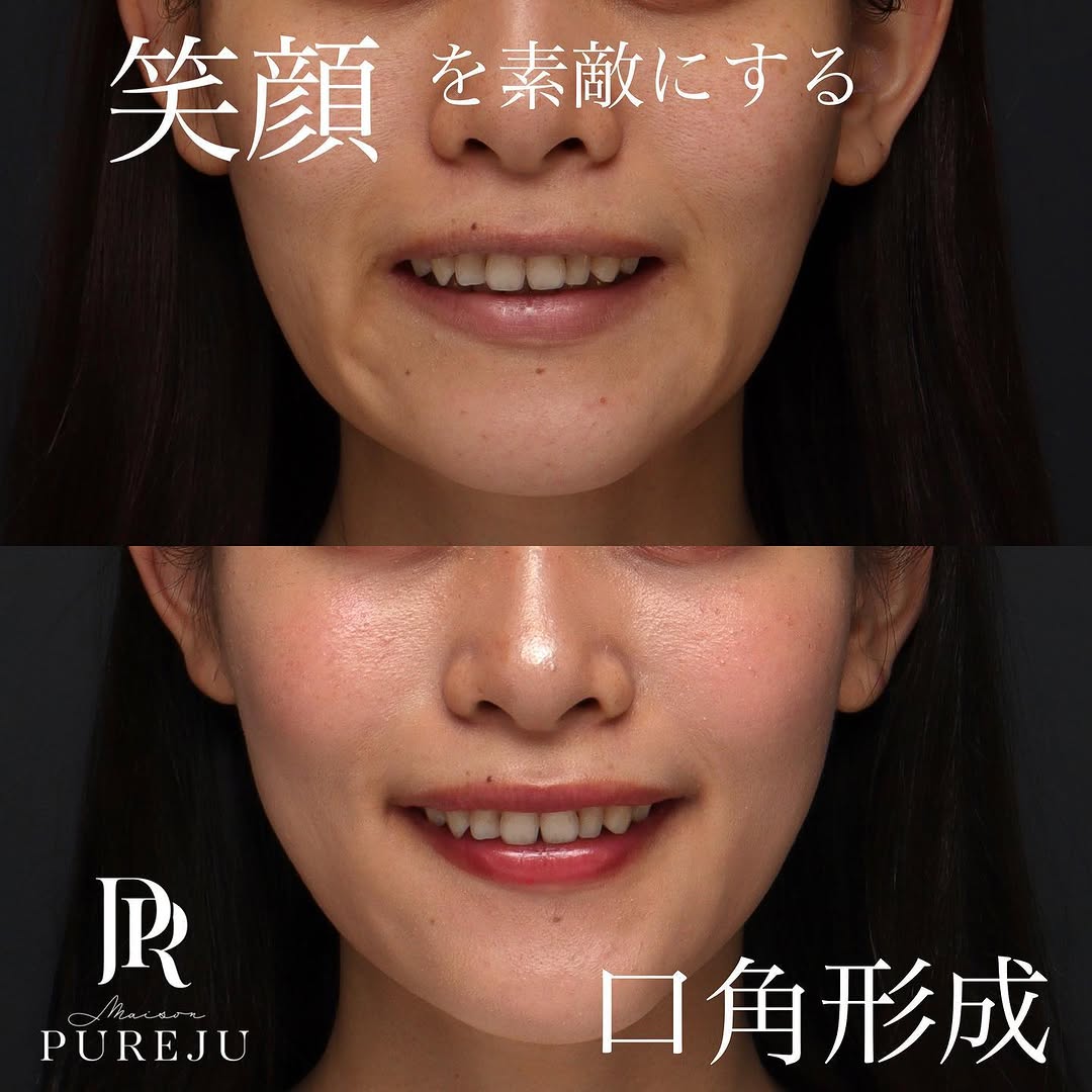 口角形成で笑顔がきれいになりぎこちなさが改善した症例 画像5