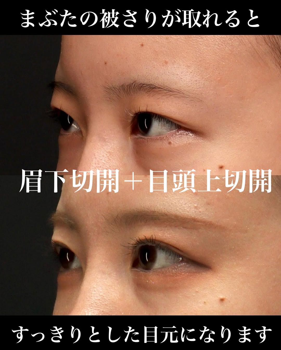 眉下切開＋目頭上切開でまぶたのたるみを全体的に改善し斜め方向も綺麗になった症例
