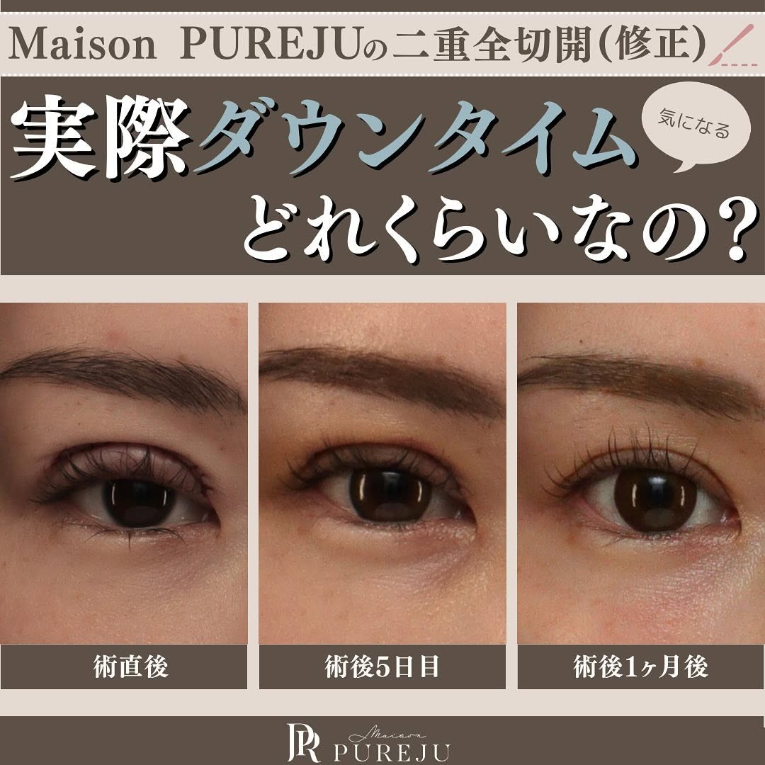 二重全切開（修正）のダウンタイムはどのくらい？術直後〜1ヶ月の経過と過ごし方を解説