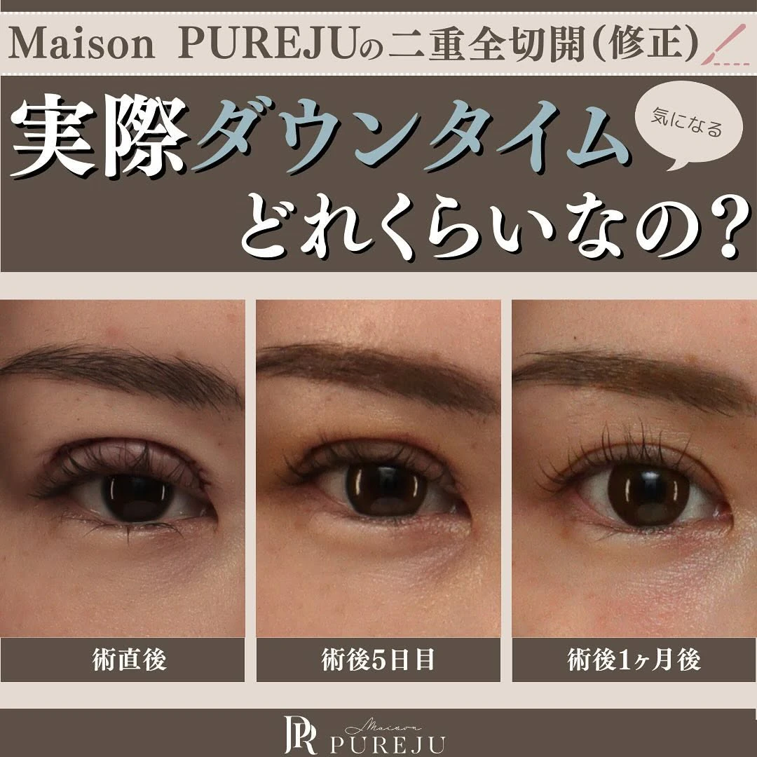 二重全切開(修正)のダウンタイムはどのくらい?術直後〜1ヶ月の経過と過ごし方を解説