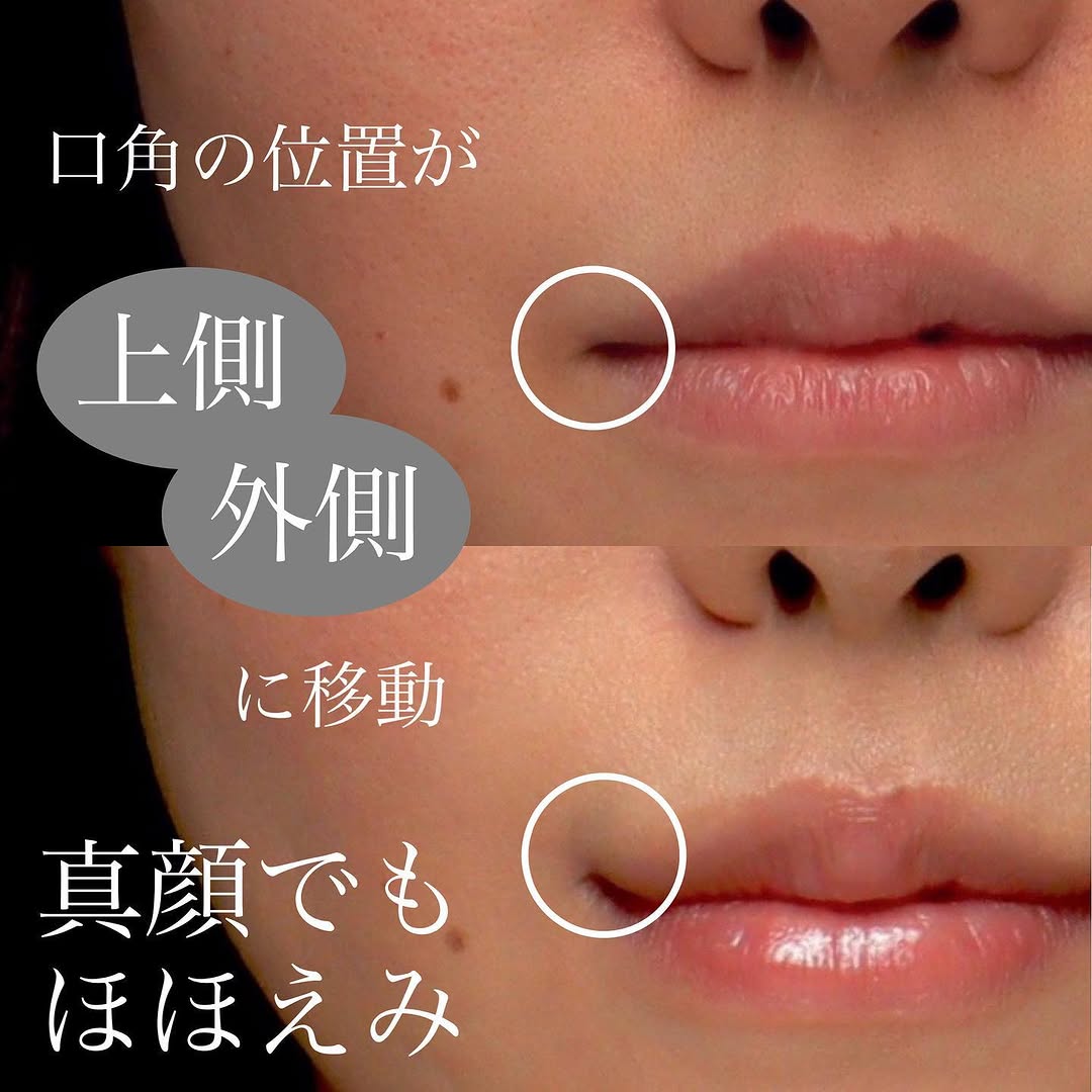 口角挙上で笑いやすさと口角の上がりを同時に改善した症例 画像4