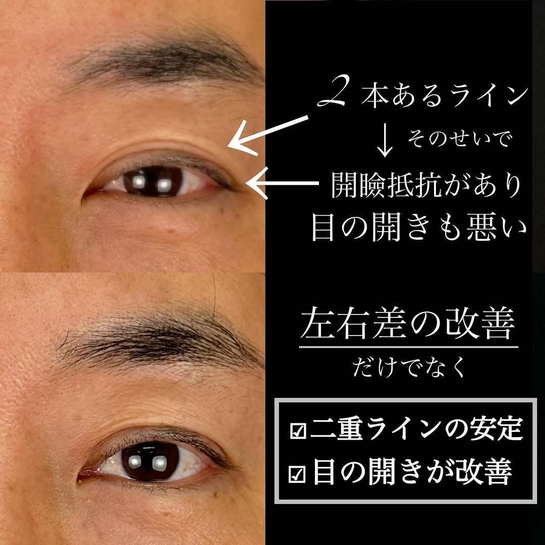二重全切開で二重ラインの左右差と余分なラインを改善した症例（術後2ヶ月） 画像2