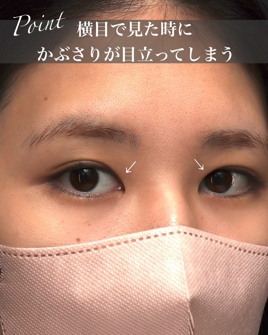 目頭上切開で目頭側のたるみを改善しどこから見てもすっきりした丸い目元に整えた症例 画像2