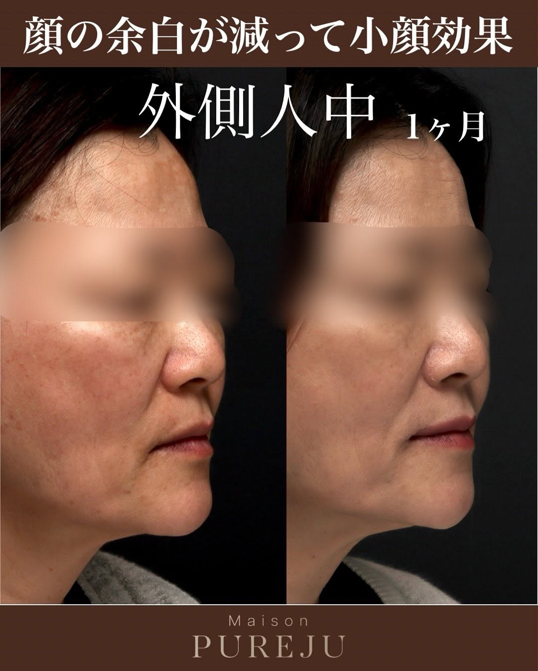 外側人中短縮で唇の外側を持ち上げお顔の余白を改善した術後1ヶ月の症例 画像2