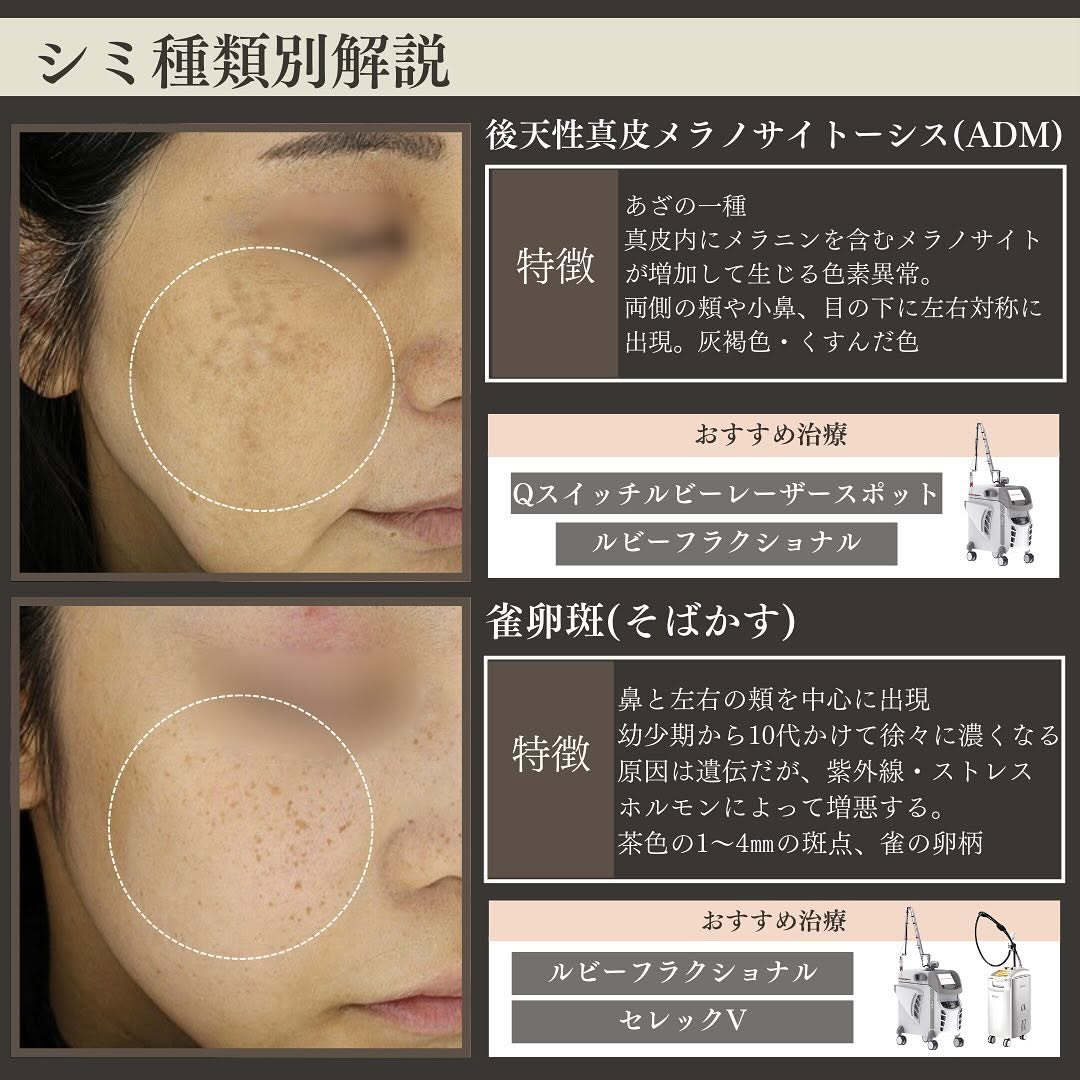 シミの種類4つを徹底解説｜ADM・そばかす・老人性色素斑・肝斑の特徴とおすすめ治療 画像2