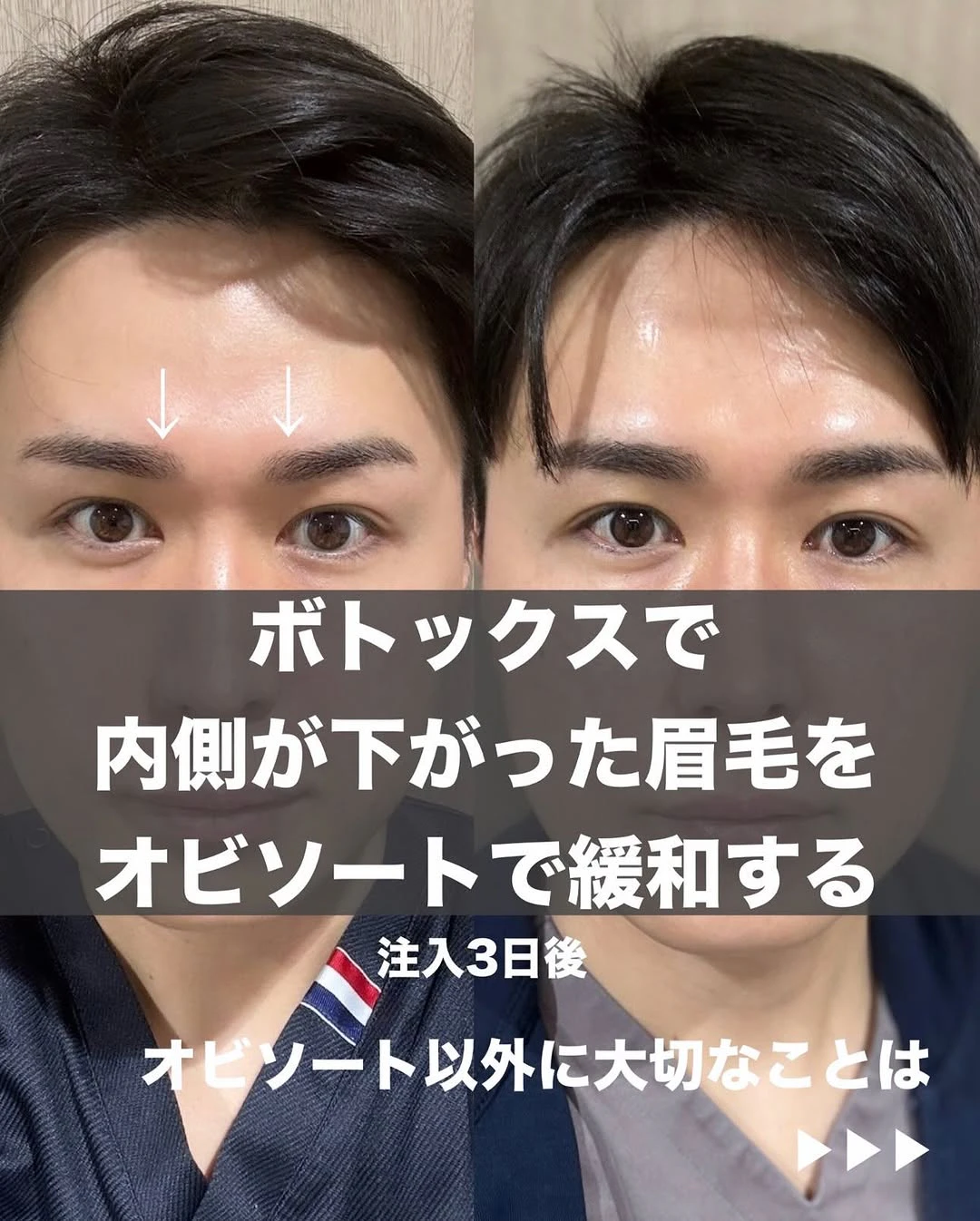 ボトックス後のスポックブローをオビソートで調整する方法