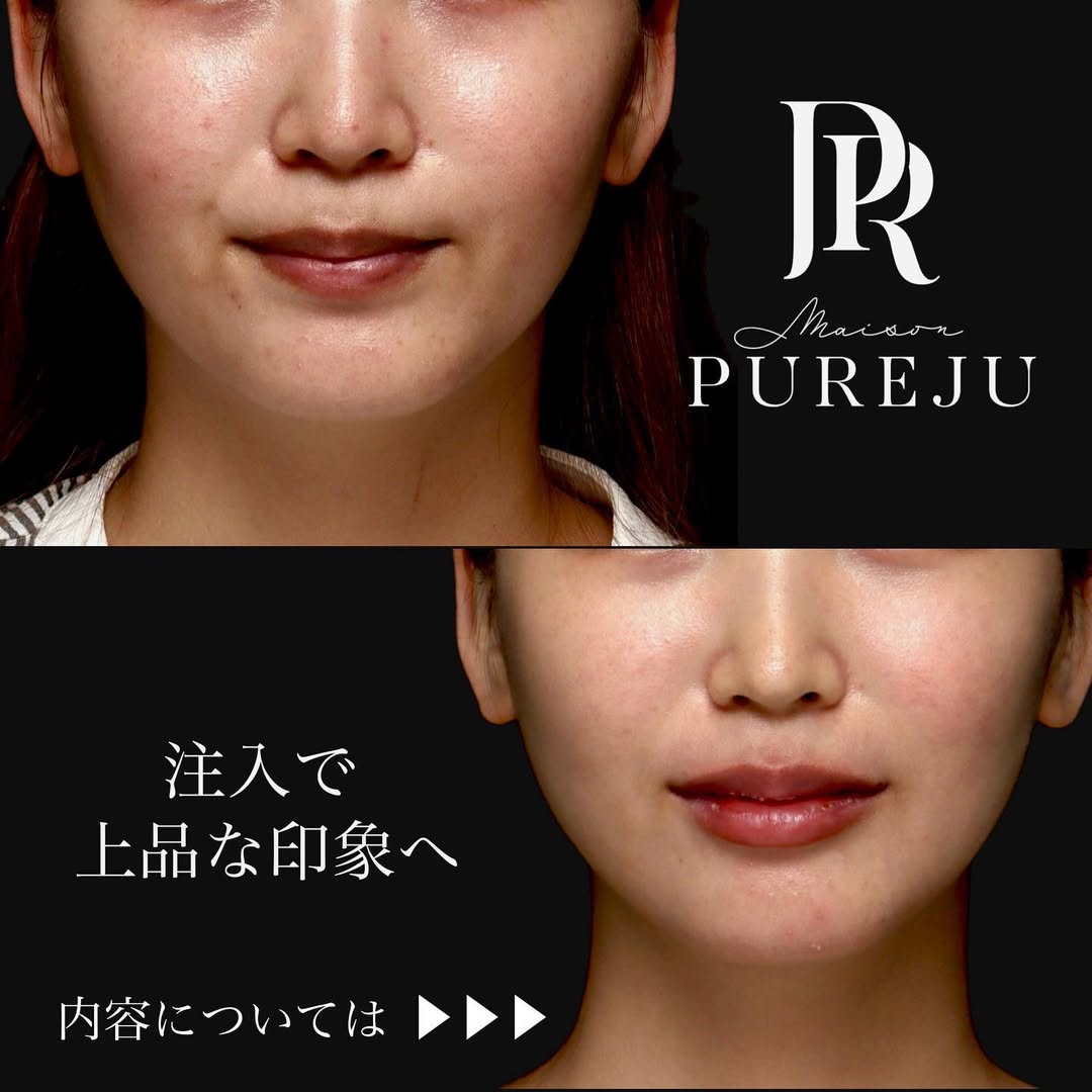 ボトックス×ヒアルロン酸（頬・唇）のトータル注入で上品な印象に整えた症例