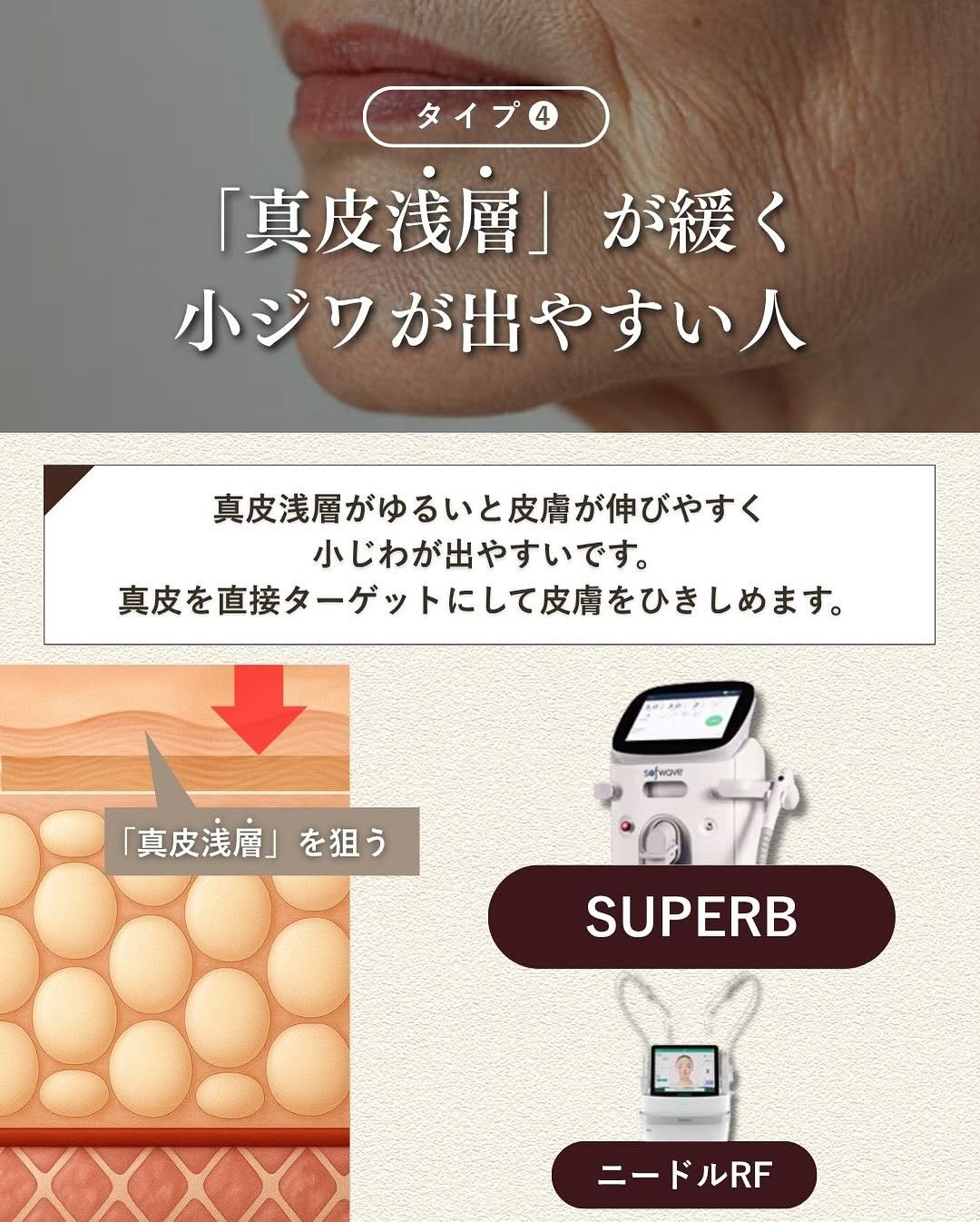 たるみ治療4層別アプローチ（機械編）｜SMAS・脂肪層・真皮深層・真皮浅層ごとに最適な機器を解説 画像5