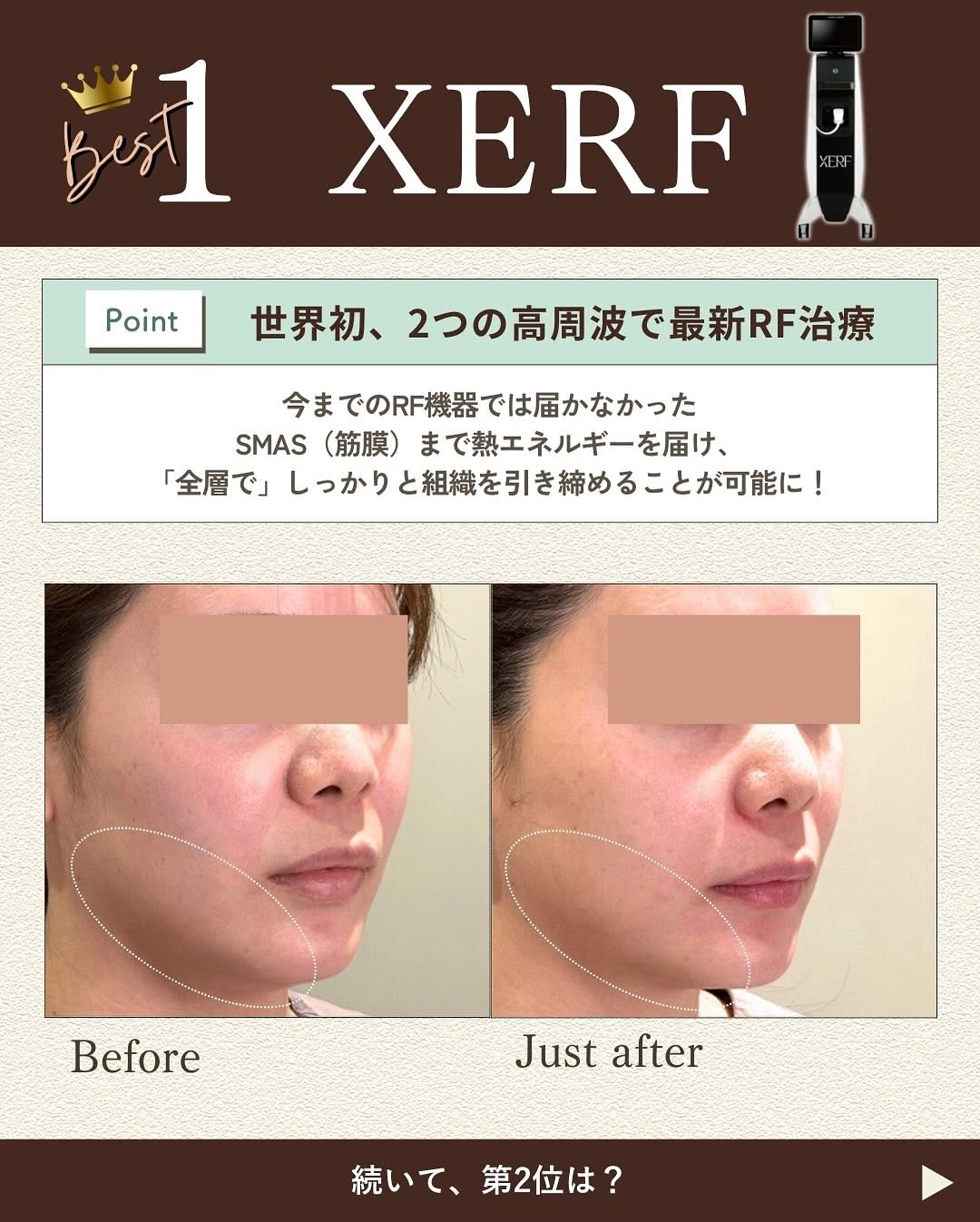 2025年上半期 人気治療ベスト3｜XERF・うるおいシルキー注射・ジェネシスが選ばれる理由 画像2