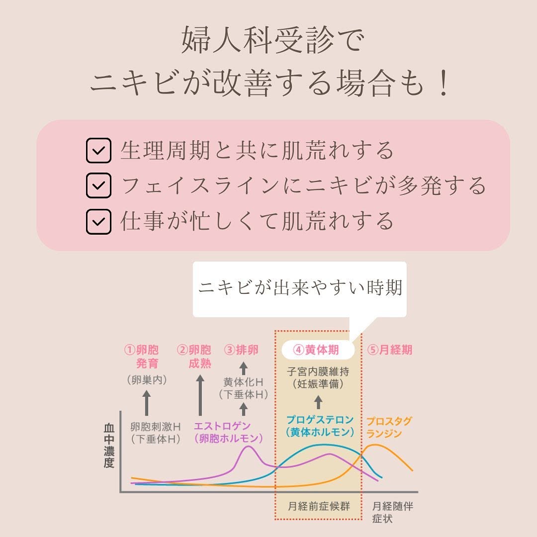 ニキビに悩む人たちへ - 私が4年間闘った経験をお伝えします 画像4