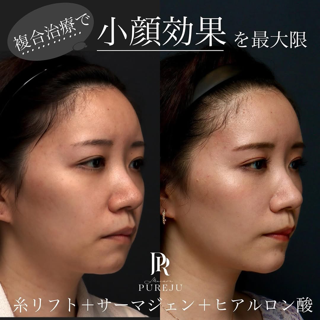 糸リフト＋サーマジェン＋ヒアルロン酸＋ボトックスのコンビネーションでバランス良く小顔に整えた症例