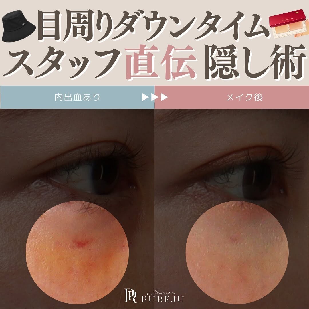 目周りのダウンタイムを隠す方法｜服装アイテムと内出血を消すコンシーラーの使い方