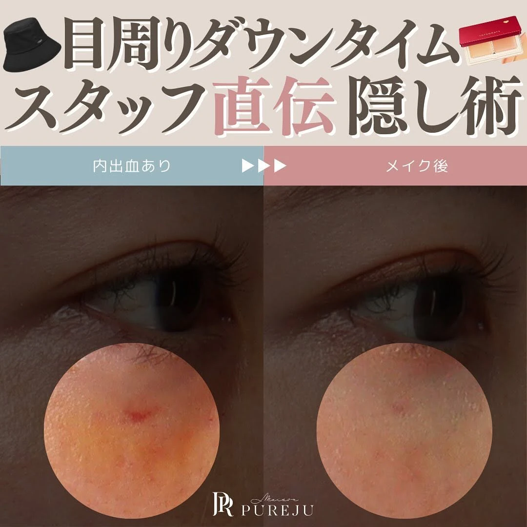 目周りのダウンタイムを隠す方法|服装アイテムと内出血を消すコンシーラーの使い方