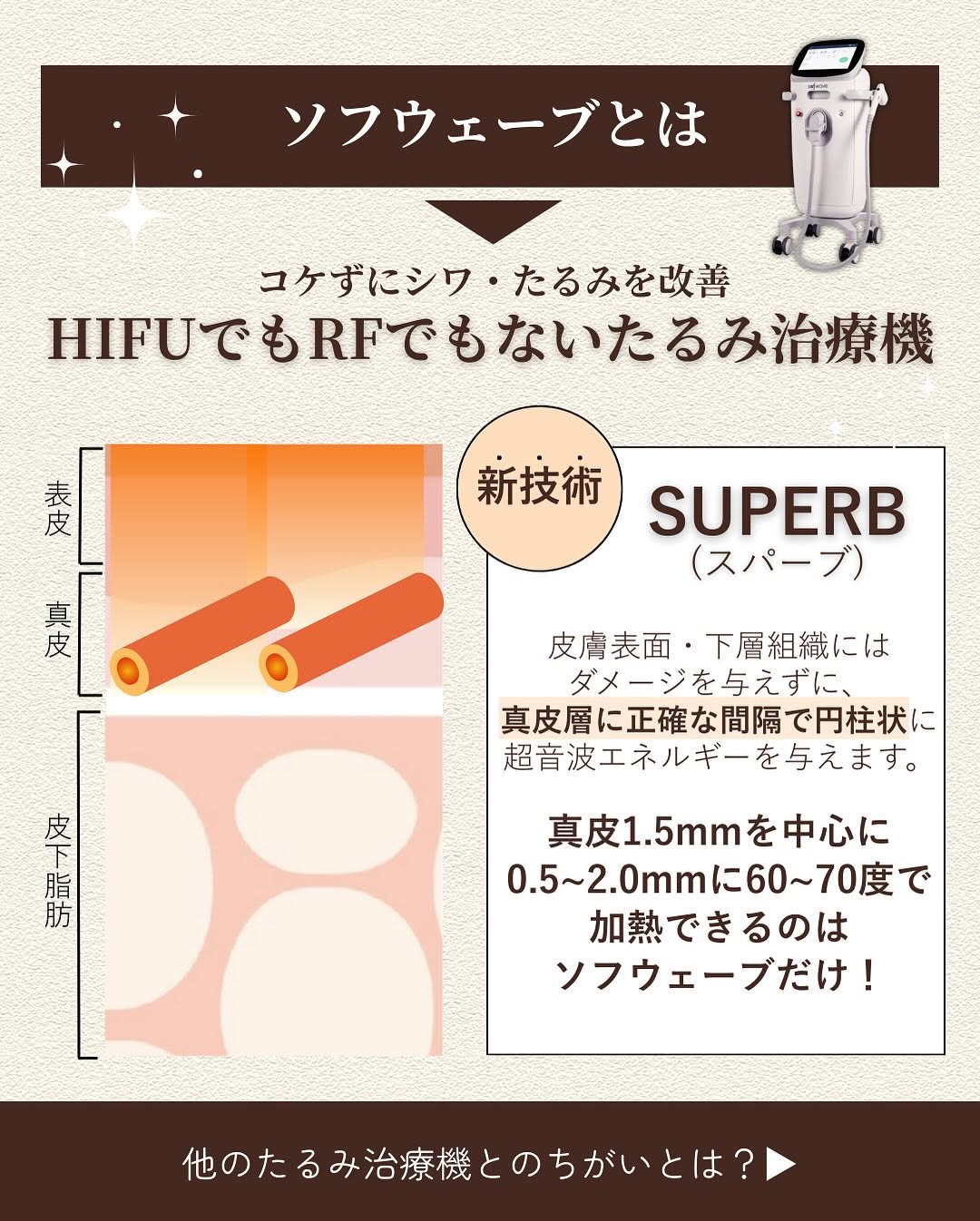 ソフウェーブとは｜厚生労働省承認の超音波たるみ治療で「お顔のアイロン」効果・皮膚引き締め・小じわ改善 画像2