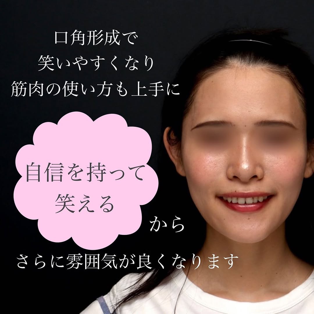 口角形成で笑顔がきれいになりぎこちなさが改善した症例 画像4