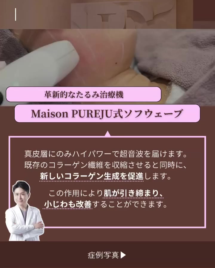 ソフウェーブで30代のフェイスラインのたるみをピタッと引き締めた症例 画像3