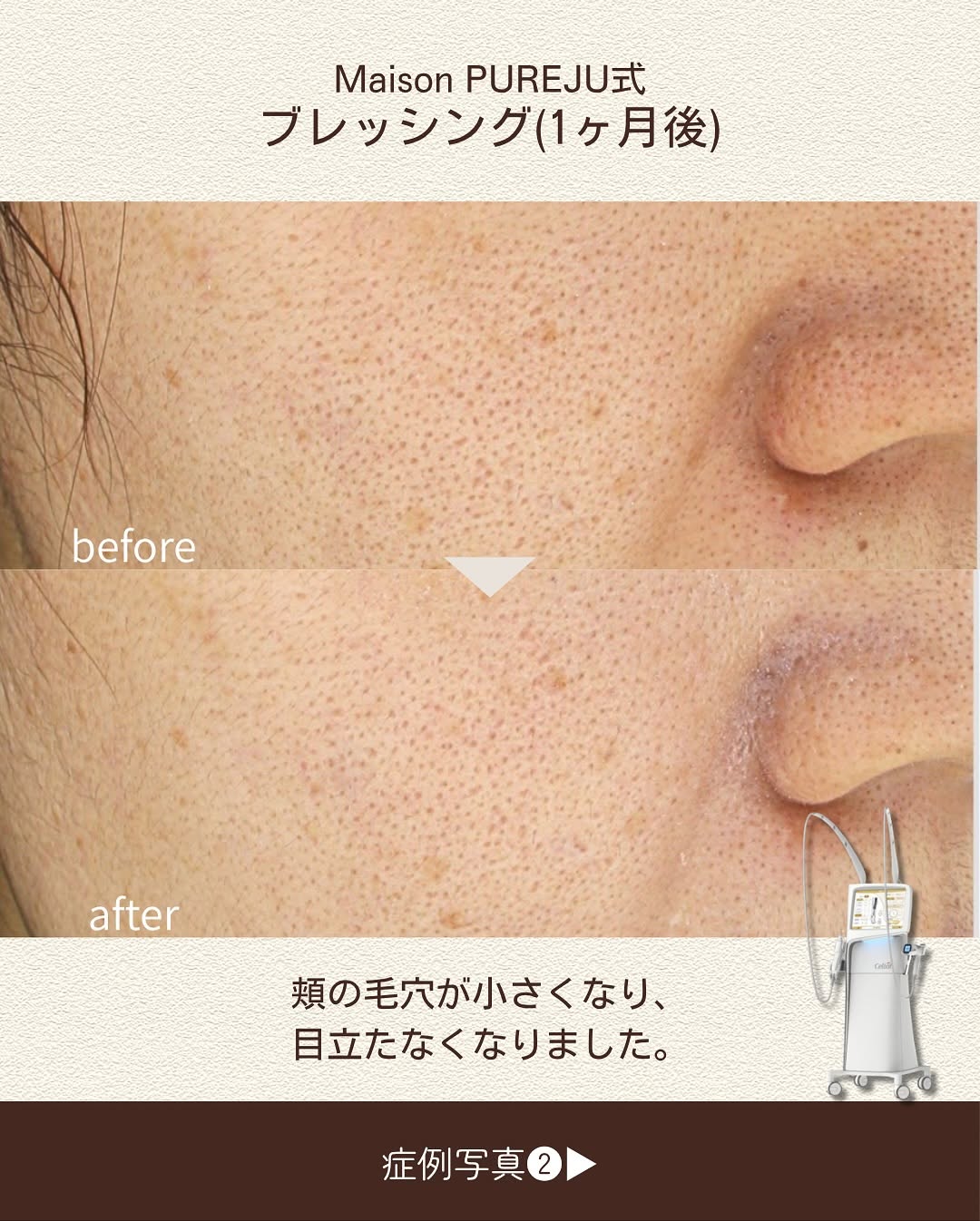 ブレッシングで頑固な毛穴をニードルRFと薬剤の相乗効果で改善した症例 画像3