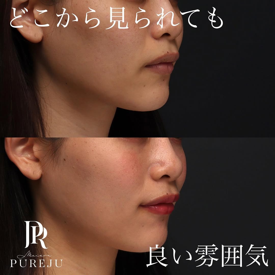 口角挙上で真顔でも印象の良い口元に整えた症例（術後1ヶ月） 画像2