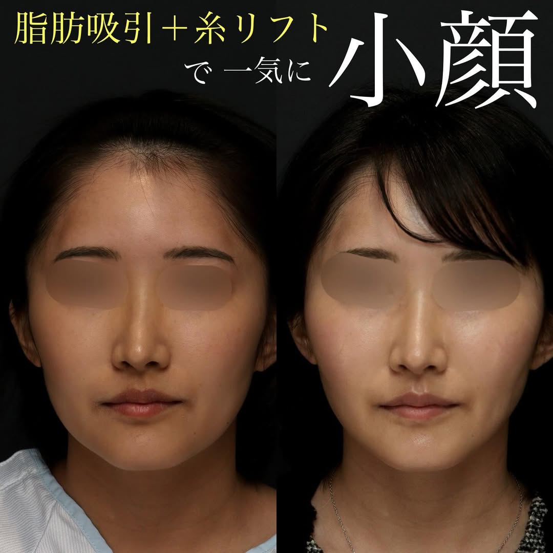 糸リフト＋脂肪吸引の組み合わせでしっかり小顔に整えた症例 画像2