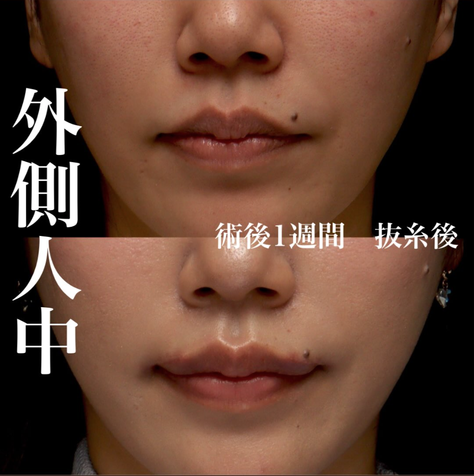 外側人中短縮で下がった唇を持ち上げ口元のバランスを整えた症例（術後1週間）