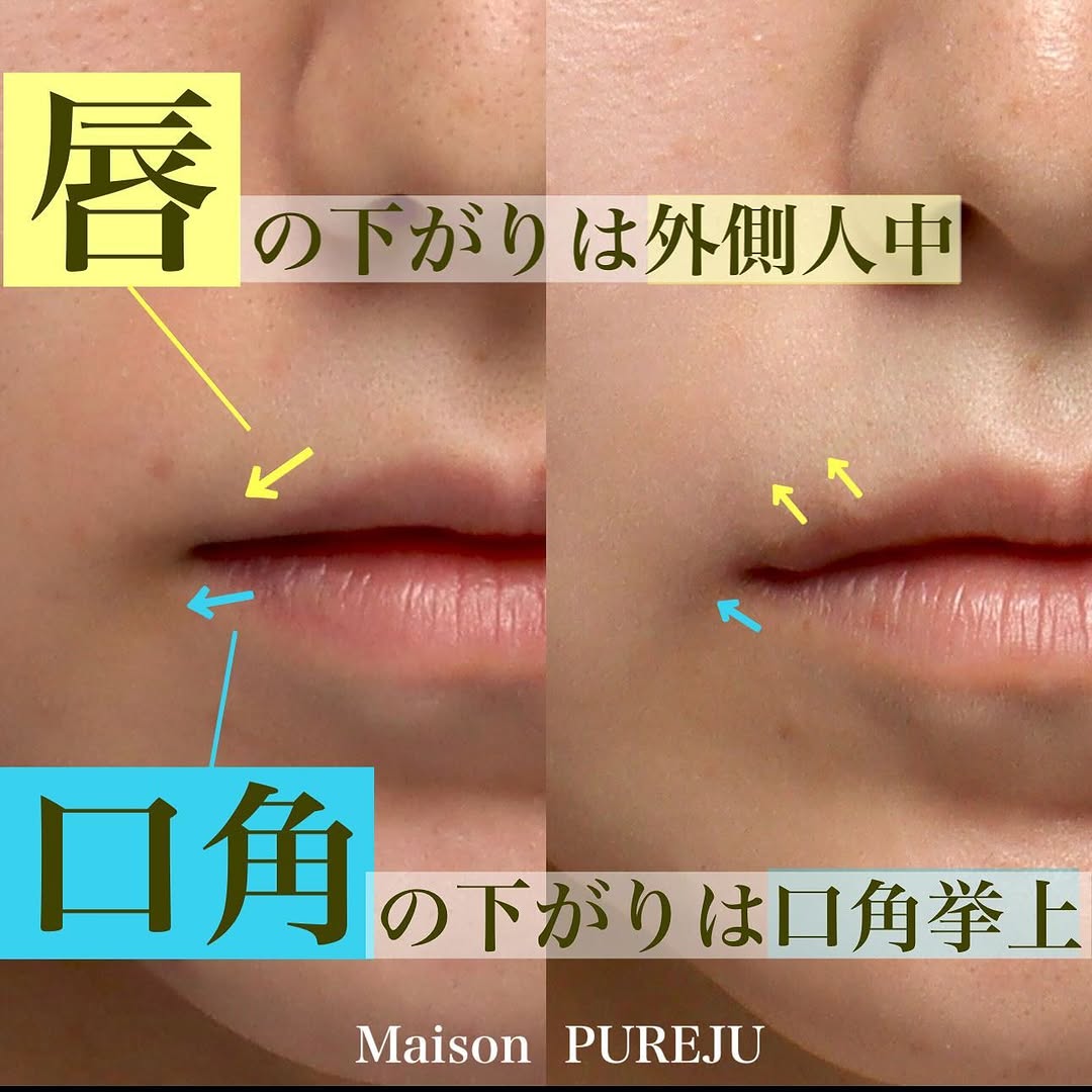口角挙上＋外側人中で口角と唇両方の下りを改善しバランスを整えた症例 画像2