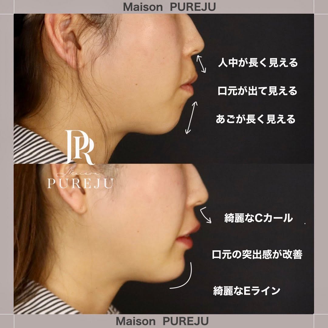 ヒアルロン酸注入で整える横顔｜あご+唇で小顔効果とEライン改善 画像2