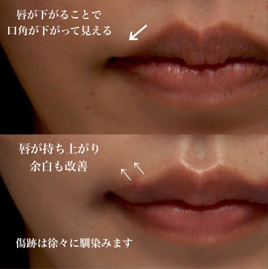 外側人中短縮で下がった唇を持ち上げ口元のバランスを整えた症例（術後1週間） 画像2