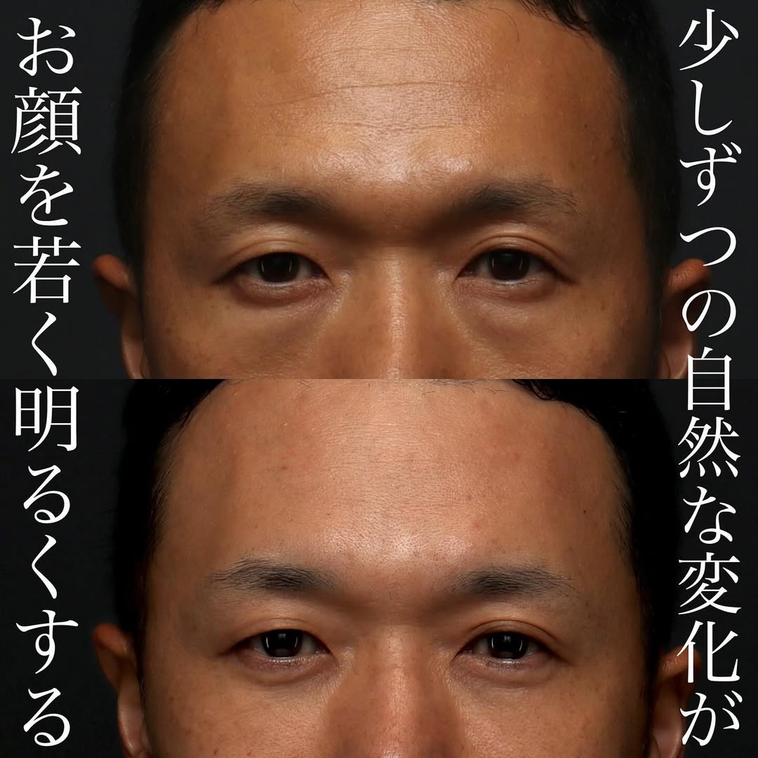 表ハムラ＋ヒアルロン酸注射＋シルキー注射で男性の自然な若返りを実現した症例（半年以上後） 画像3