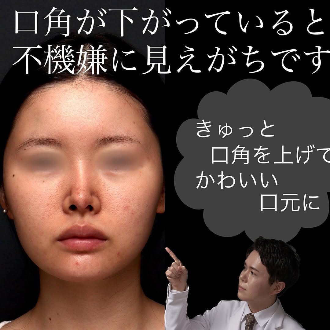 口角挙上でふとした瞬間の口角を上げ第一印象を改善した症例 画像2