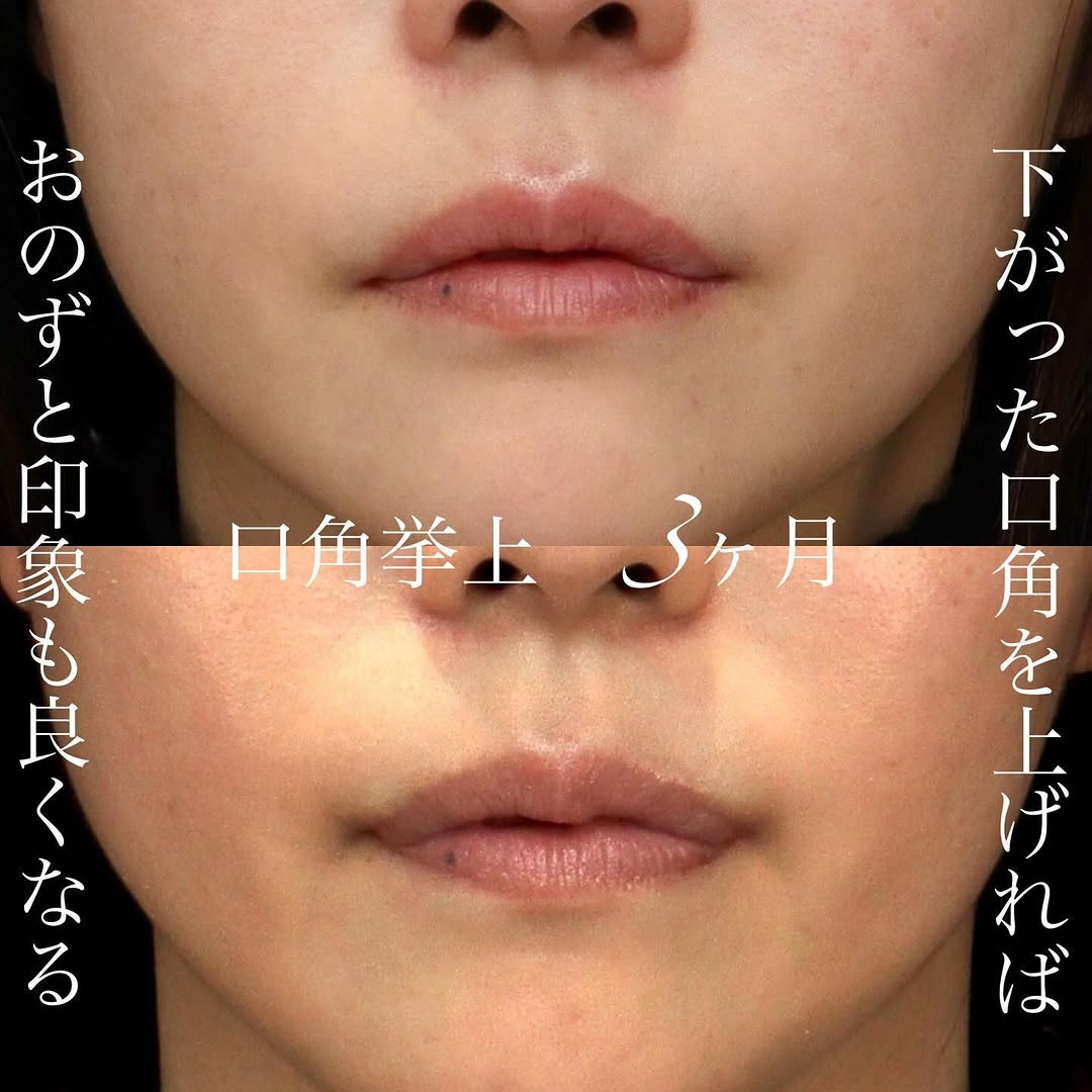 口角挙上でふとした瞬間・斜めから見ても口角が上がっている印象の良い口元に整えた症例 画像2