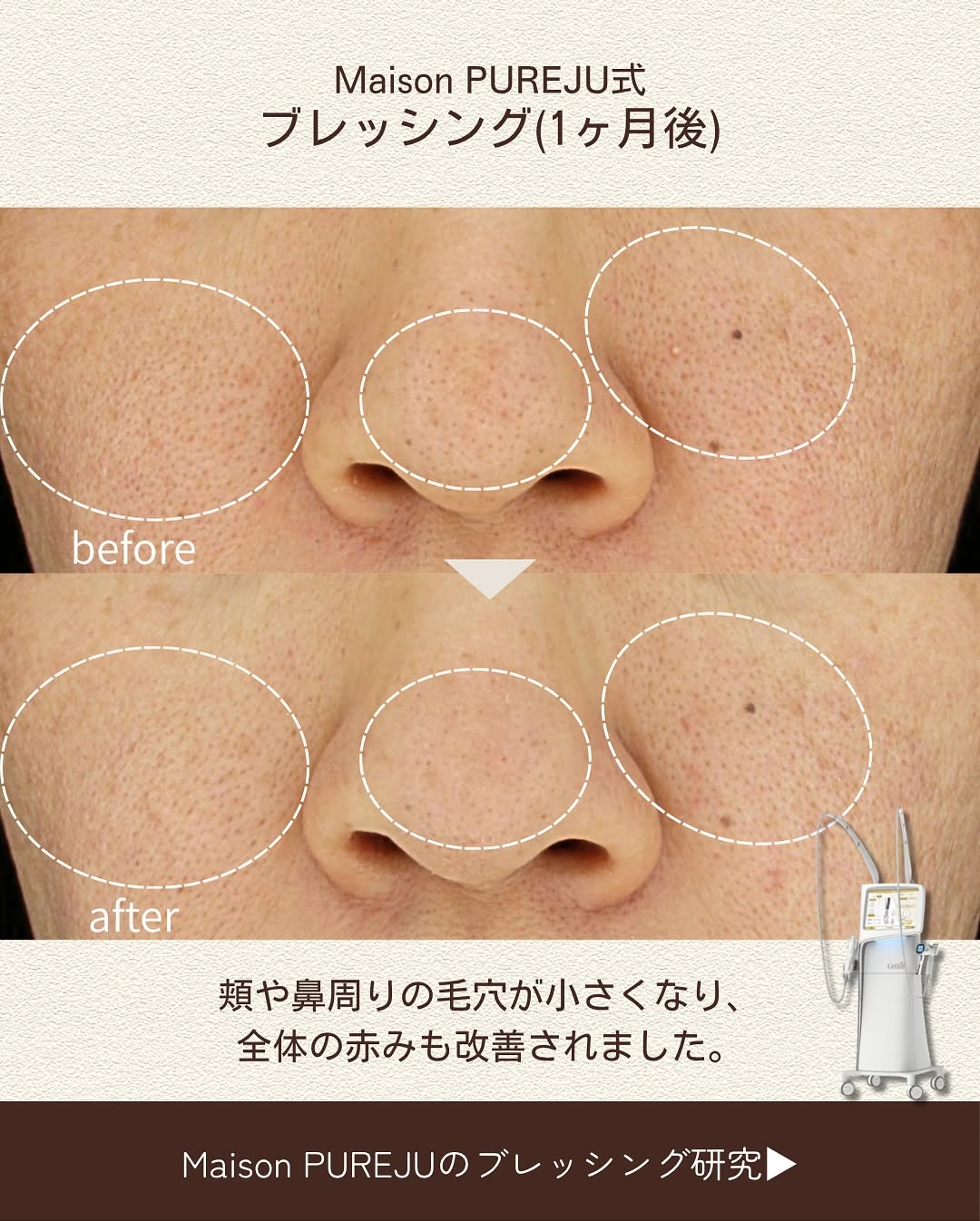ブレッシングで頑固な毛穴をニードルRFと薬剤の相乗効果で改善した症例 画像4
