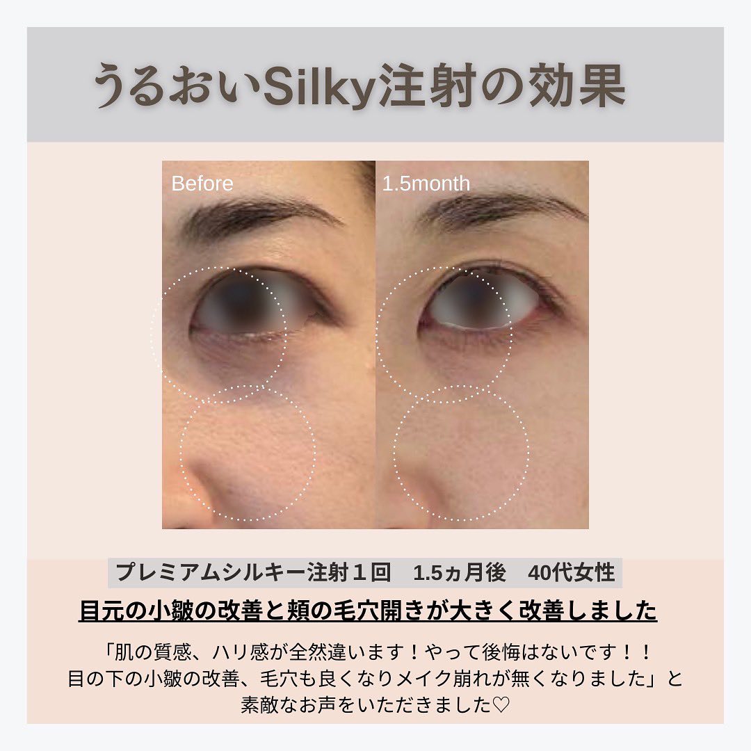 うるおいSilky注射とは｜数十種類の美容有効成分を直接注入する当院オリジナルスキンブースター 画像5