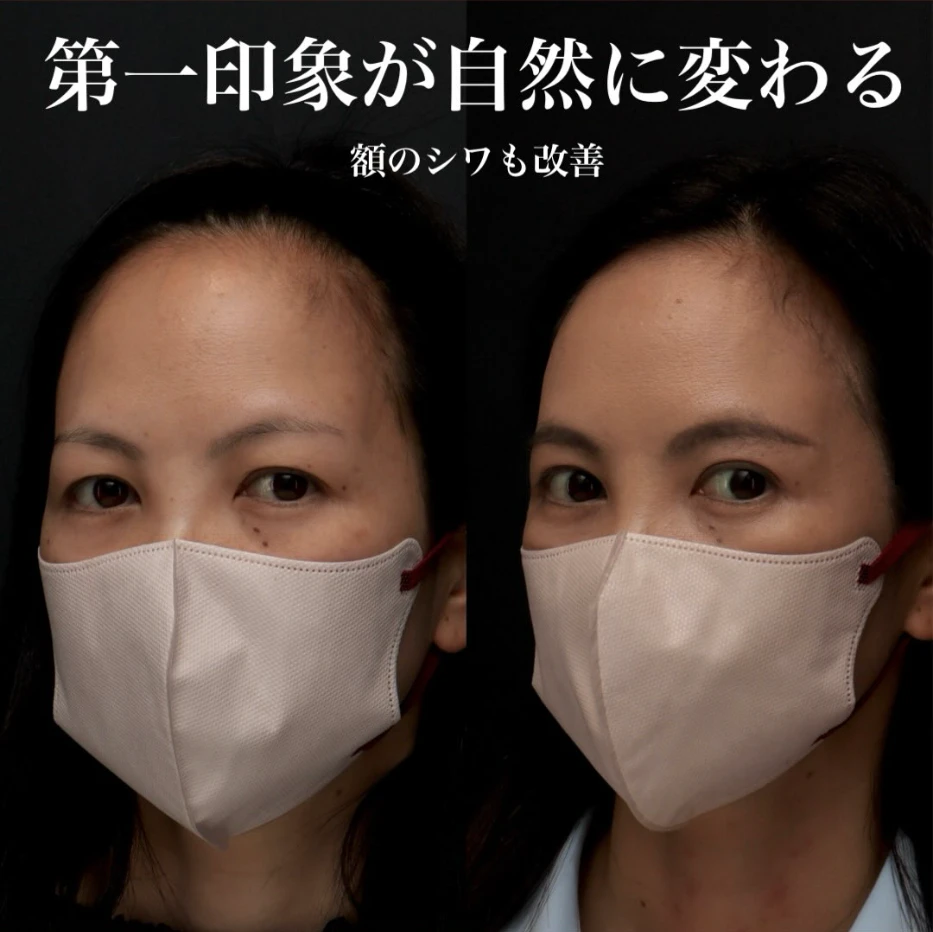 眉下切開で目尻側のたるみを取り自然に目元を若返らせた症例(術後6ヶ月・メイクなし)