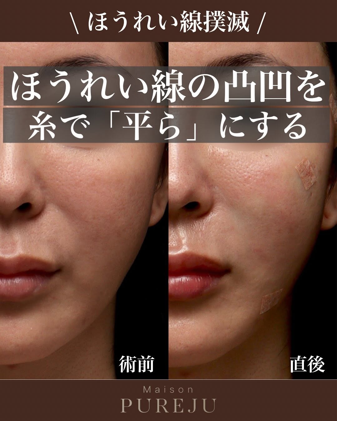 マルチフィル＋フラットリフト＋糸リフトでほうれい線の段差を平らにした症例