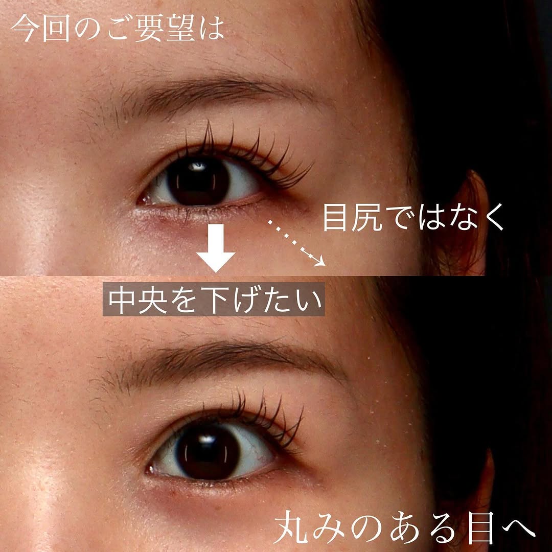 脱脂（くまとり）＋グラマラス（たれ目形成）で中顔面が短く見える丸い目元に整えた症例 画像3