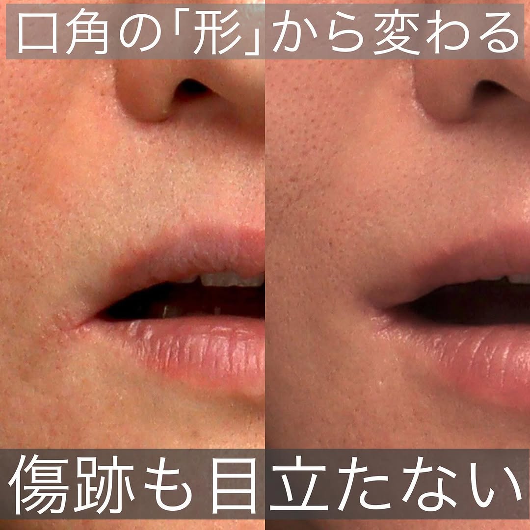 口角挙上で「口角が下がっていない」自然な口元の印象を整えた症例 画像3
