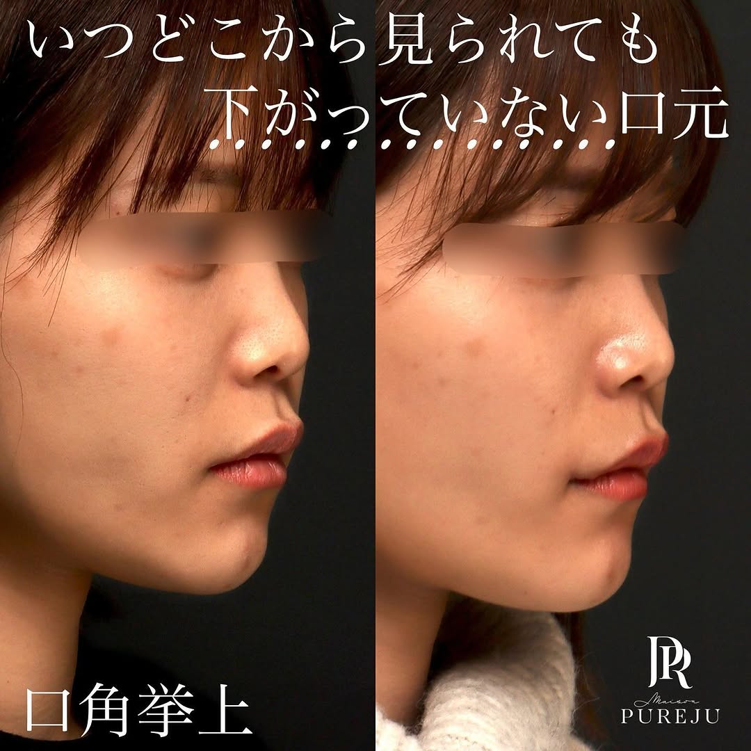 口角挙上で真顔でも斜めから見ても口角が下がっていない自然な口元に整えた症例 画像2