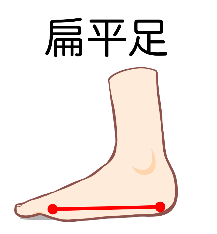 扁平足 | ピラティスアヴニール