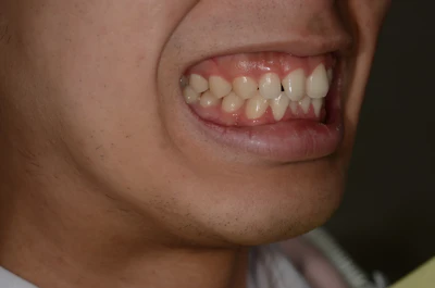 ガミースマイルの治療前の歯並び（治療例）