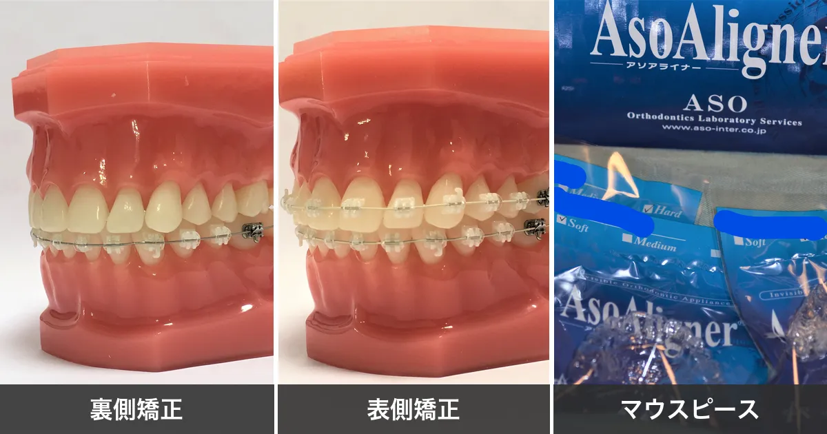 裏側・表側・マウスピース矯正の比較