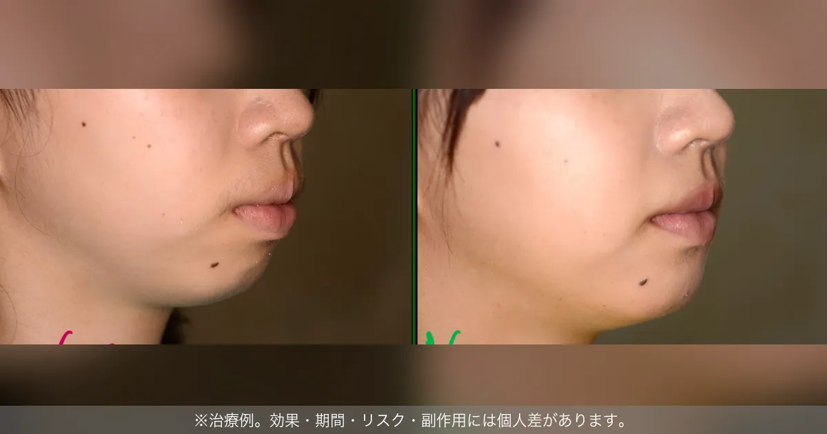 出っ歯治療の横顔ビフォーアフター（治療例）