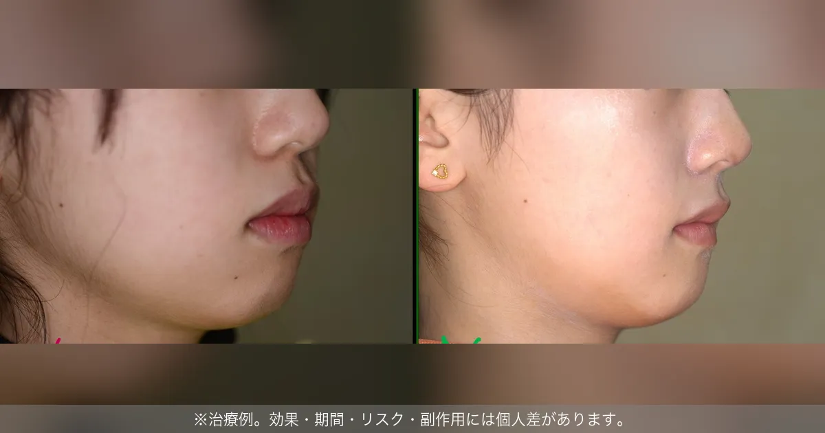 抜歯・非抜歯の横顔ビフォーアフター（治療例）