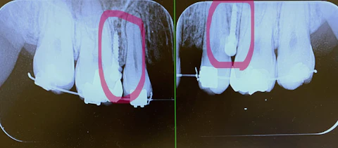 矯正後