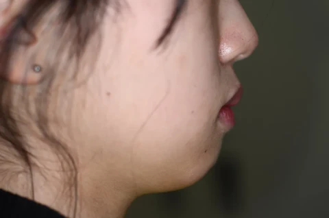 矯正前