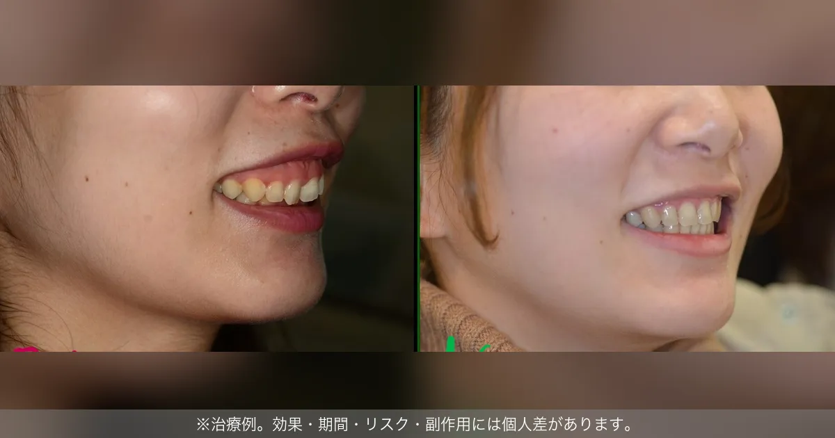 ガミースマイル治療の横顔ビフォーアフター（治療例）